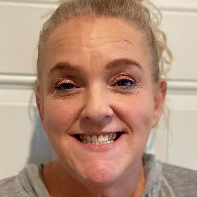 Dental Implants for Lasting Confidence - After