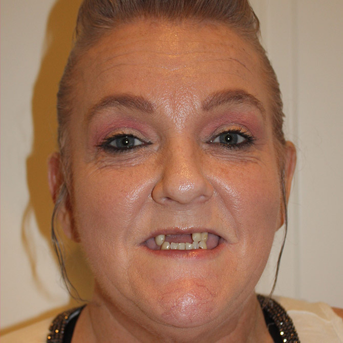 Dental Implants for Lasting Confidence - Before