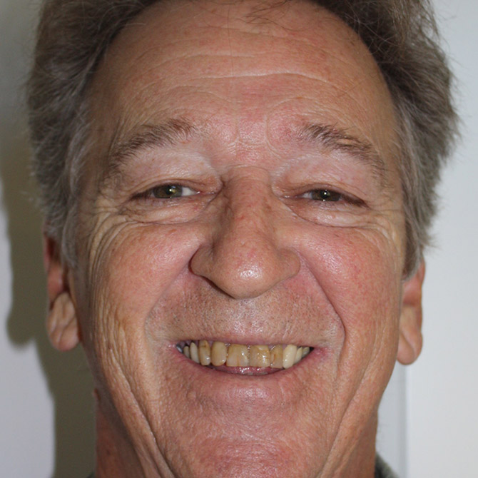 Cosmetic Dentistry for a Radiant Look - Before
