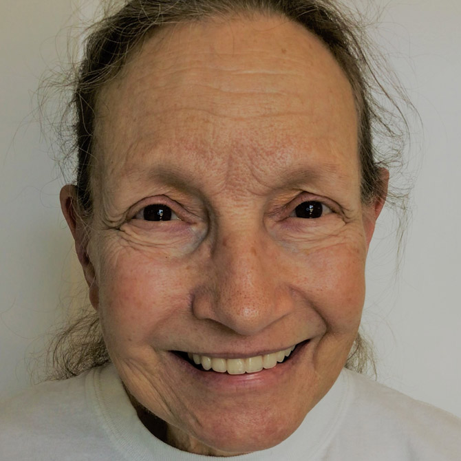Full Reconstruction for a Healthy Smile  - After