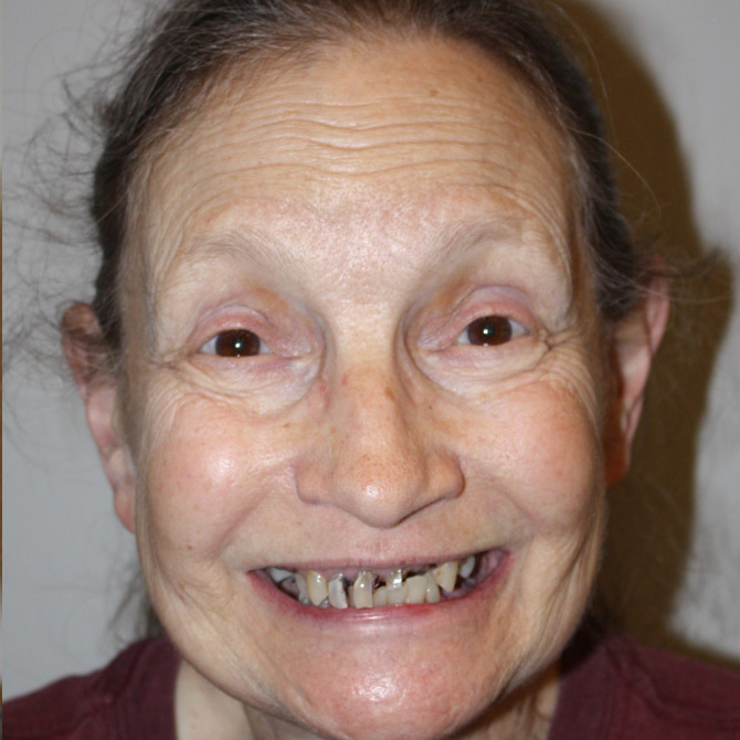 Full Reconstruction for a Healthy Smile  - Before